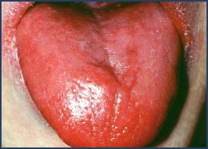 Atrophic glossitis (source)