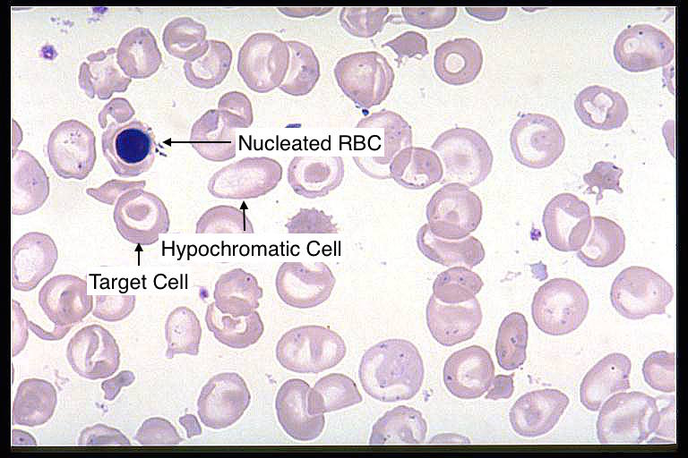 Blood smear (May-Giemsa stain) of a patient with beta-thalassemia (source)