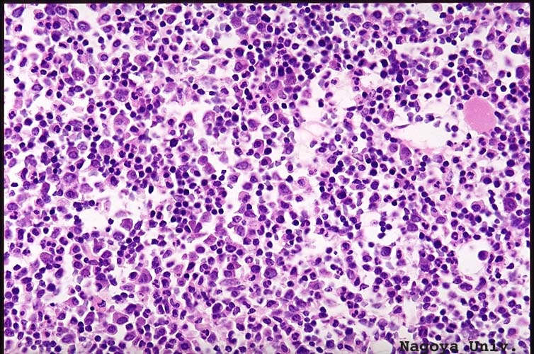 Bone marrow biopsy of patient with ALL (source) 