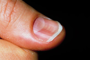 Spoon nail that can be seen in patients with iron deficiency (source)