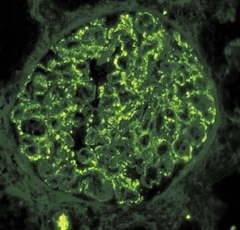 Immunoflourescance of PSGN with the typical "starry sky" appearance (source)