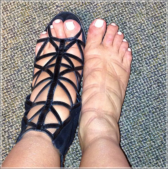 Peripehral edema (such as above in the feet) can be observed in patients with preeclampsia (source)