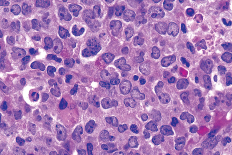 Large amounts of myeloblasts can be observed in the bone marrow of this patient with CML blast crisis (source)