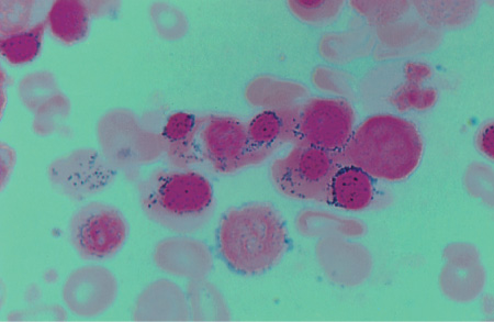 Ringed sideroblasts found in patient with sideroblastic anemia (source)