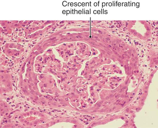 Crescentic glomerulonephritis. Not specific to a single disease, however will be observed in Goodpasture syndrome (source)