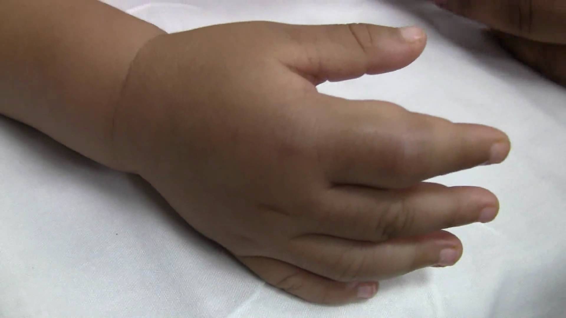 Swelling in the hands of a patient with sickle cell disease (source)