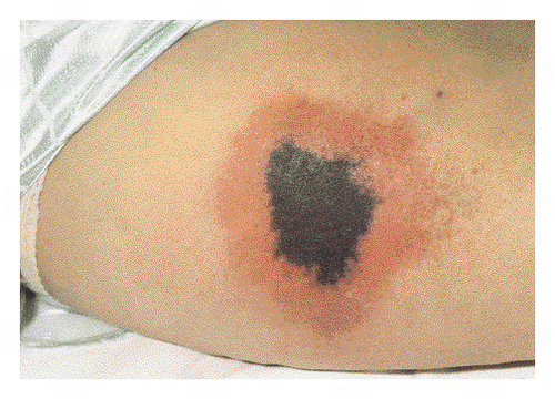 Heaprin induced skin necrosis at the site of injection in a patient with HIT (source)