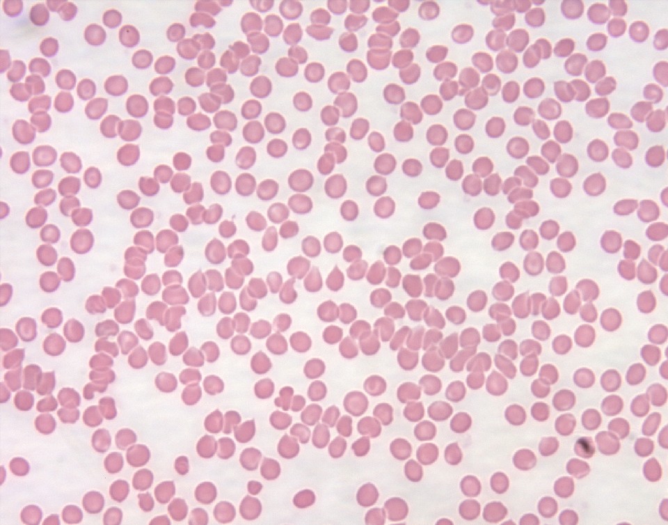 Normal blood smear of a healthy patient (source)