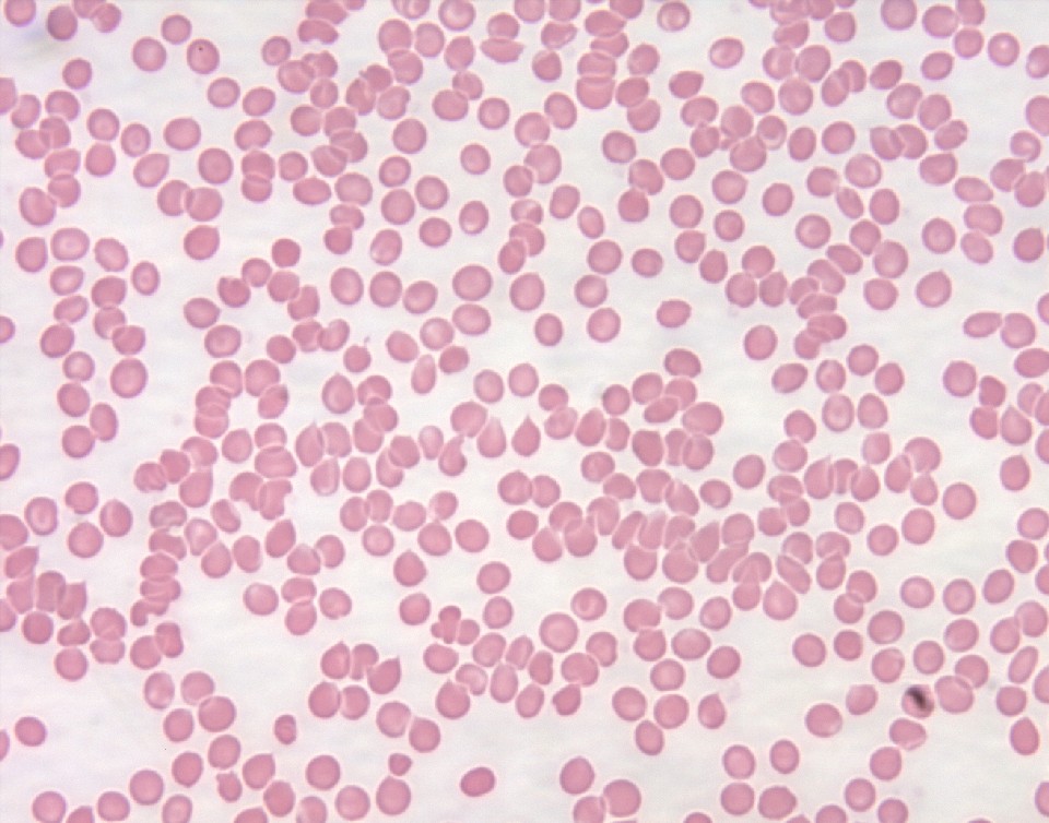 Immune Thrombocytopenic Purpura ITP Stepwards