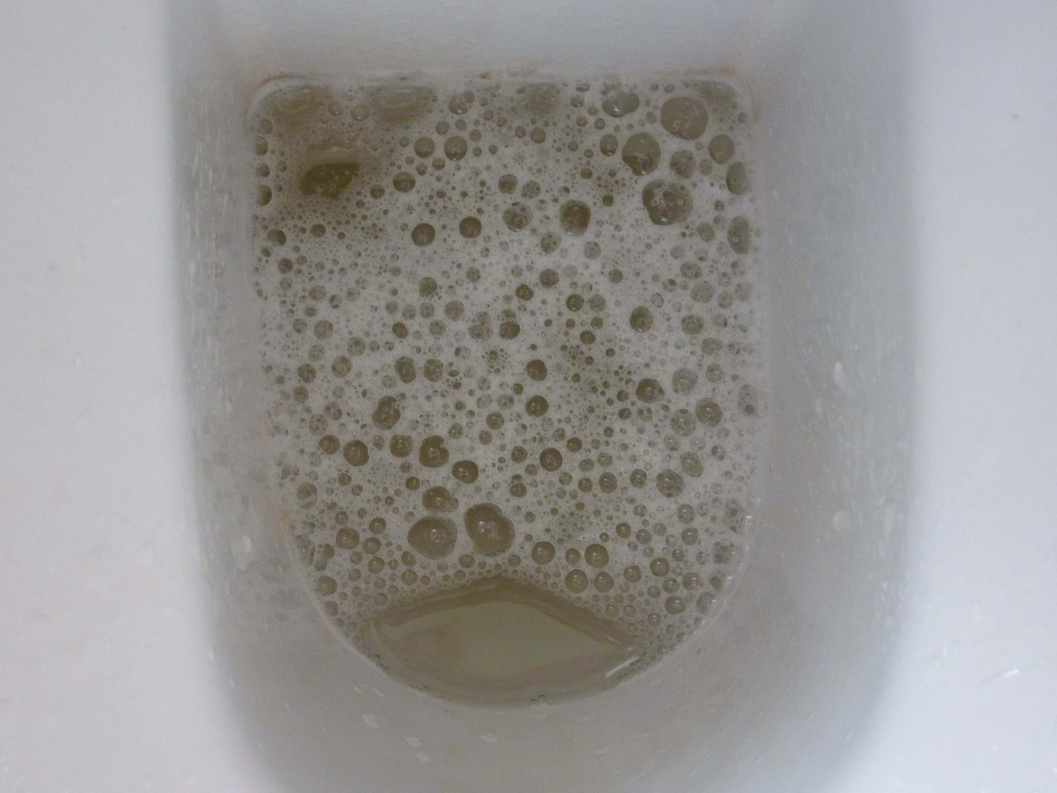 Frothy urine might be one of the first signs a patient notices (source)