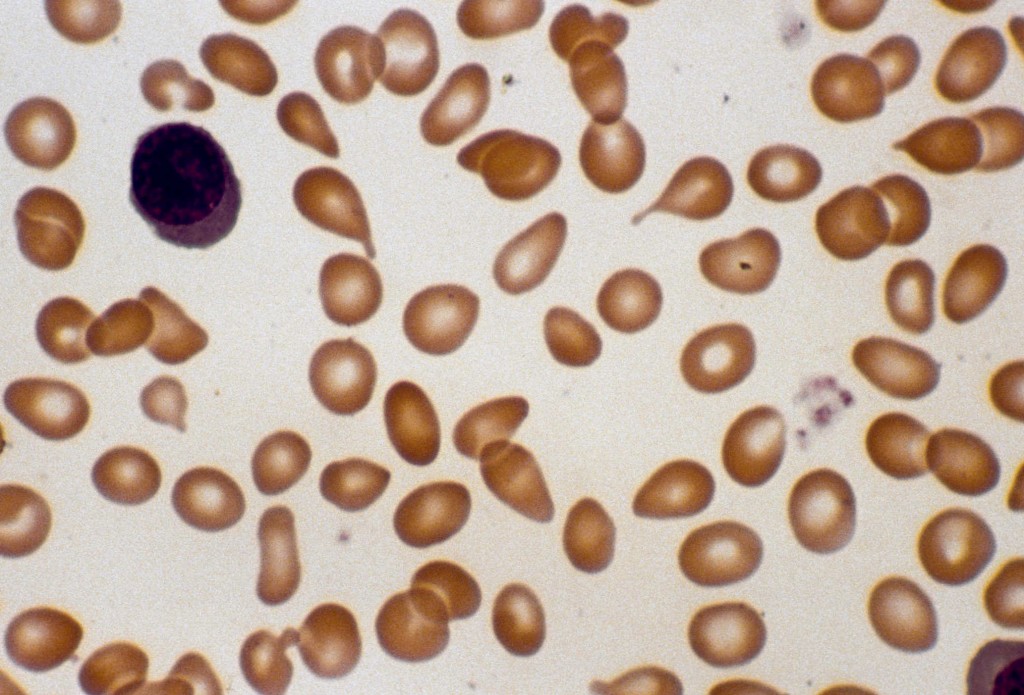 Peripheral blood smear of patient with myelofibrosis showing teardrop shaped RBCs (source) 