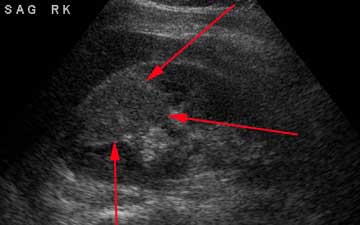 Ultrasound findings of pyelonephritis (source)