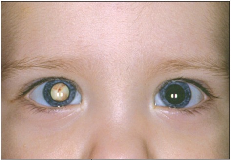 The patient above has a normal red reflex in the left eye, and an abnormal one in the right eye. This abnormal finding is caused by a retinoblastoma in this patient (source)