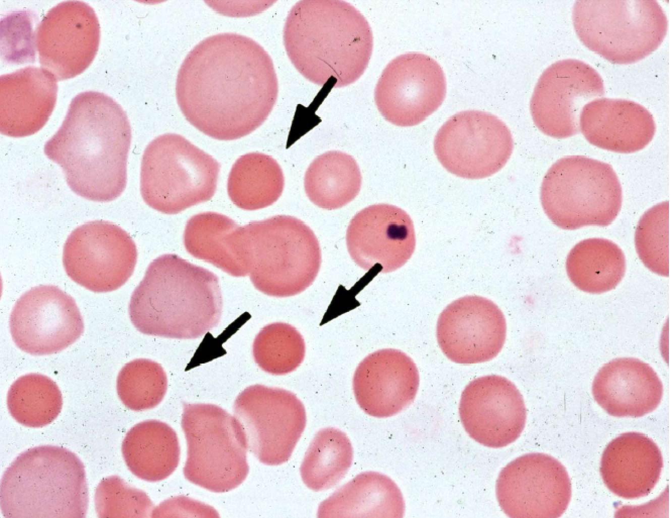 Arrows point to the spherocytes seen on this blood smear (source)