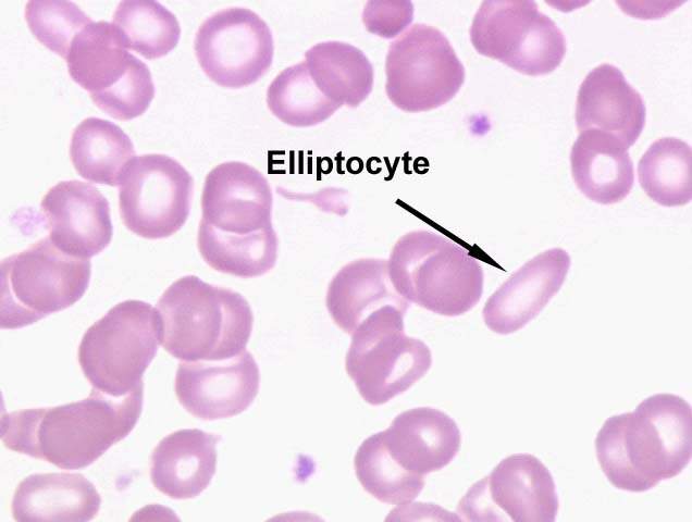 Elliptocyte seen on blood smear (source)