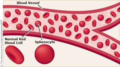 Comparison of normal and spherocyte red blood cells (source)
