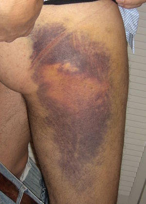 A possible clinical presentation of a subcutaneous hematoma (source)