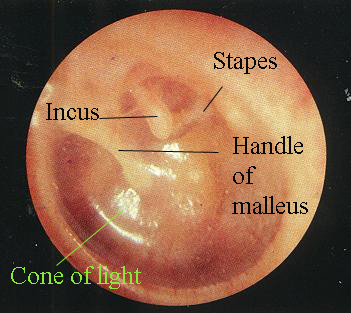 Anatomy of a normal tympanic membrane (source)