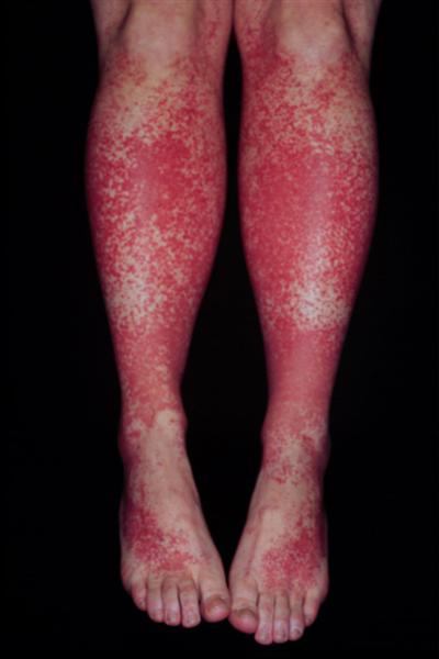 Physical finding of purpura seen on the legs of a patient (source)