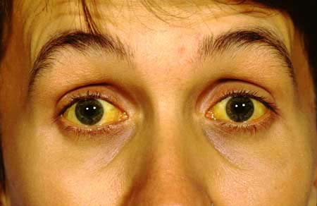 Scleral icterus in a jaundiced patient (source)