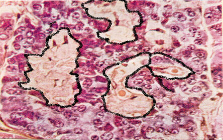 Histological analysis of islet amyloid (outlined) in the pancreas (source)