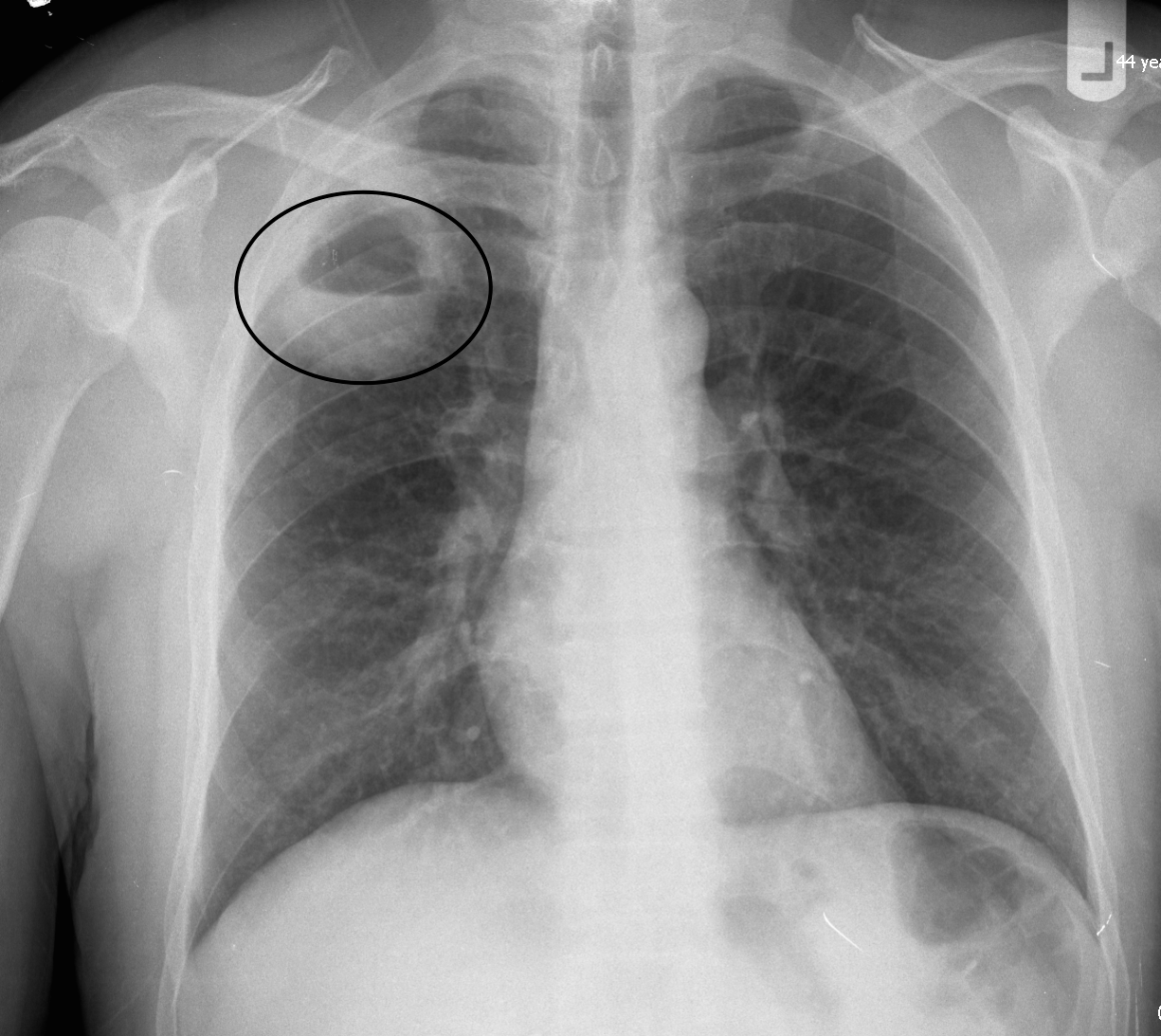 Air and fluid filled lung abscess on X-ray (source)