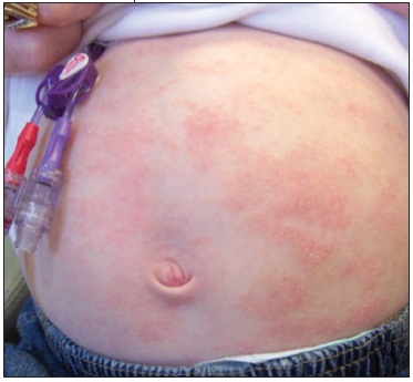 Eczema in a patient with Wiskott-Aldrich syndrome (source) 
