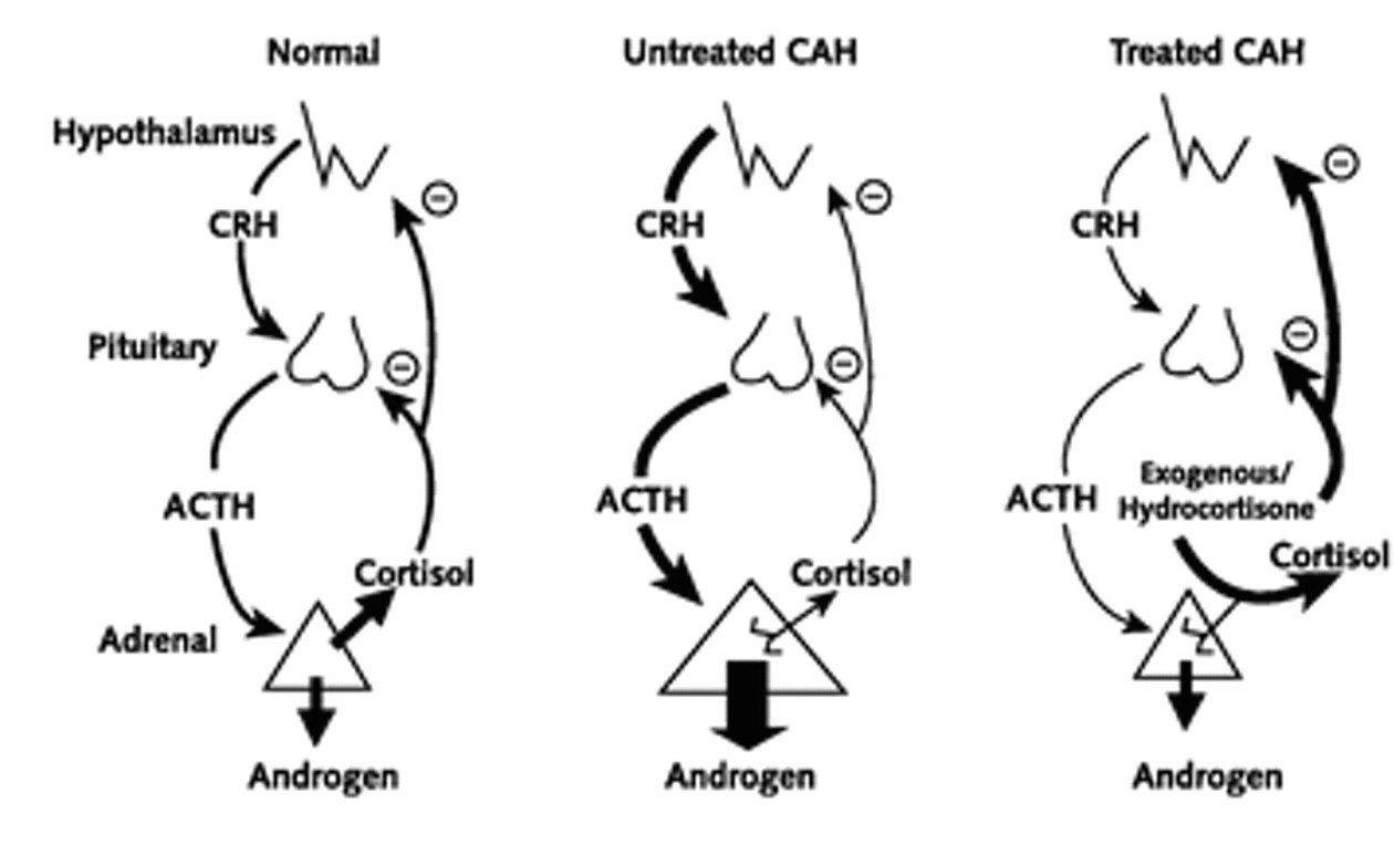 Hormone signaling pathways seen in normal, untreated CAH, and treated CAH (source) 
