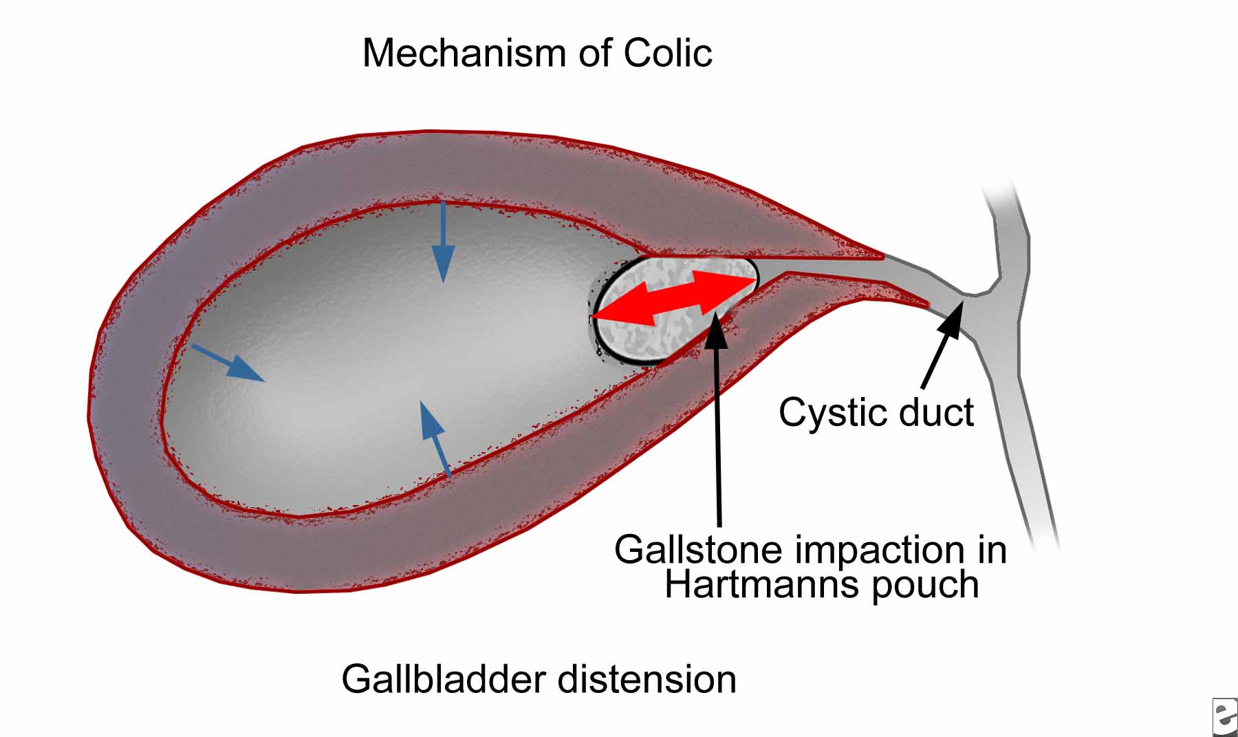 Mechanism and anatomy of billiard colic (source) 