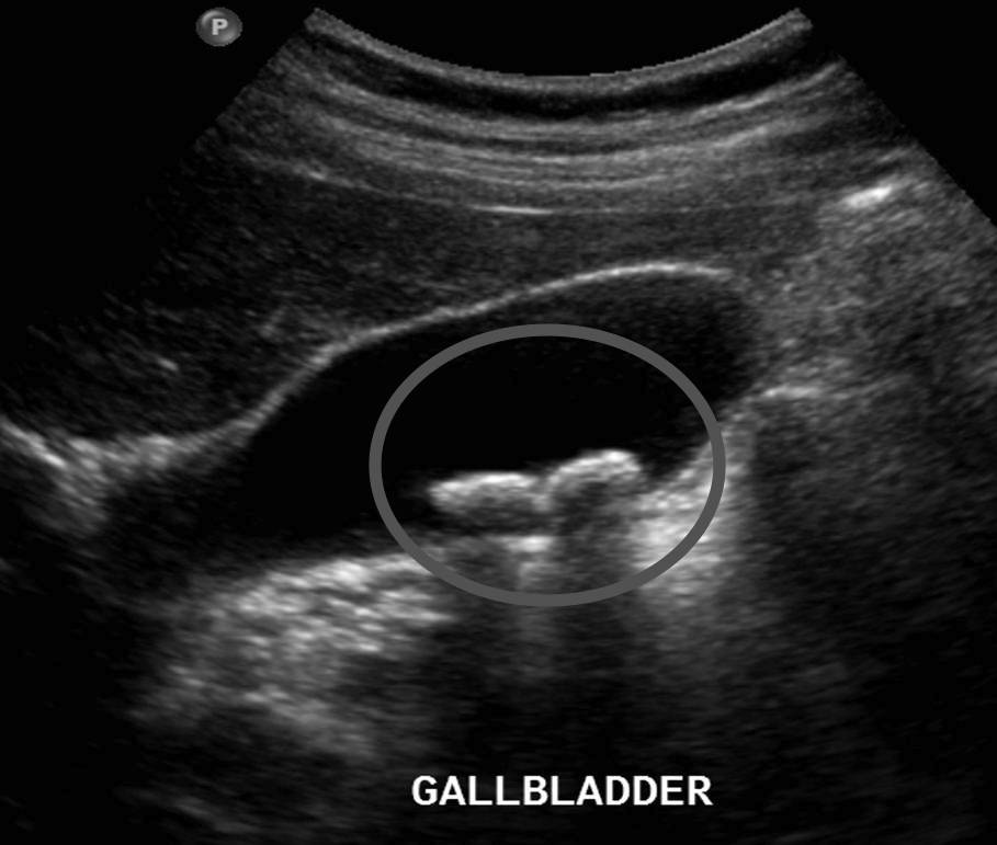 Visual appearance of gallstones on ultrasound (source) 