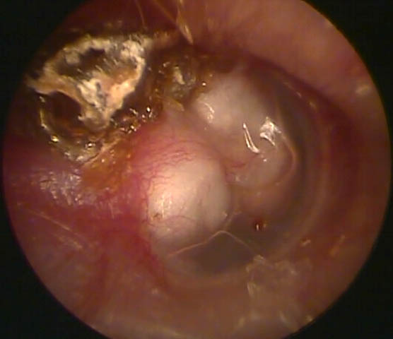 Visual appliance of cholesteatoma when looking inside the ear (source) 