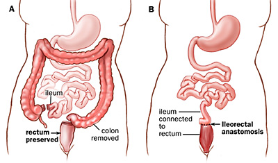 Colectomy technique often used to cure ulcerative colitis (source) 