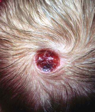 One possible clinical presentation of aplastic cutis congenita (source)