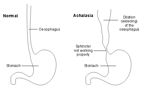 Loss of LES relaxation is the anatomical abnormality in achalasia (source) 
