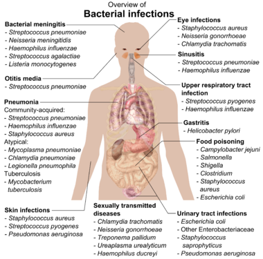 It is important to use one's physical exam to evaluate for the presence of infectious processes. The figure above summarizes many bacterial causes, however viral infections can also precipitate DKA (source)