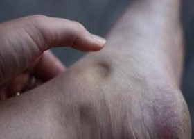 Pitting edema in a patient with diabetic nephropathy (source). 