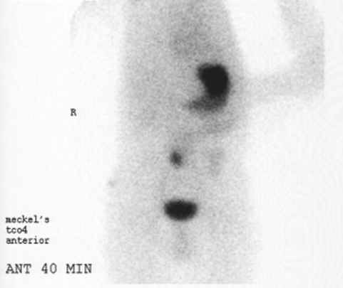 Meckel scan showing findings of Meckel diverticulum (source) 