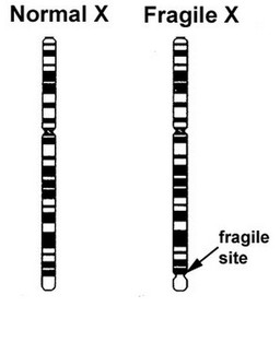 This finding on cytogenetics/karyotype is why this condition is called "fragile X" (source) 
