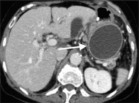 Pancreatic pseudocyst seen on CT scan (source) 