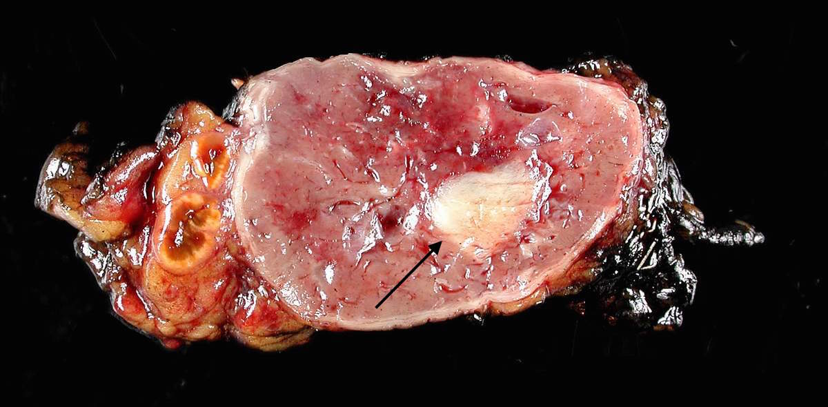 Gross pathology showing a pheochromocytoma in the adrenal medulla (source) 