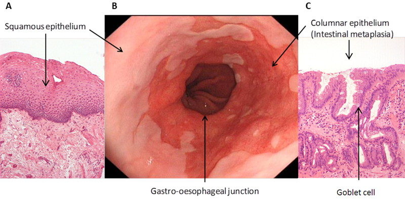 Endoscopic and histologic findings of Barrett's esophagus used for diagnosis (source)