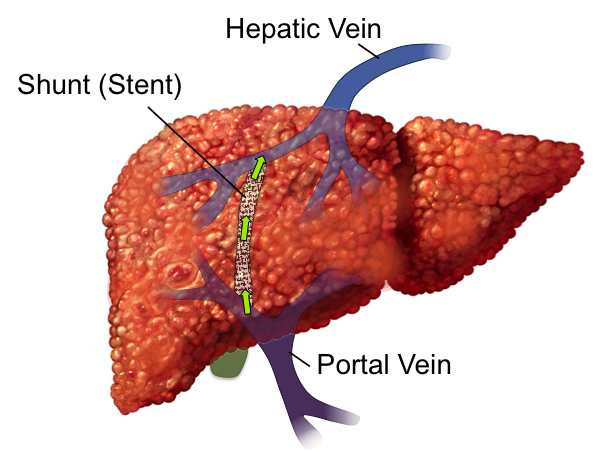 The TIPS procedure creates the shunt seen above to bypass the liver (source) 