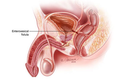 Enterovesicular fistual formation diagramed here (showing a fistula between the colon and the bladder, source)