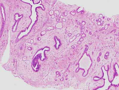 Histological analysis of fibroadenoma (source) 