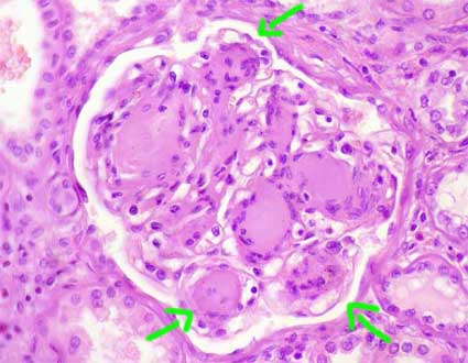 Presence of nodules in a patient with diabetic nephropathy (source) 