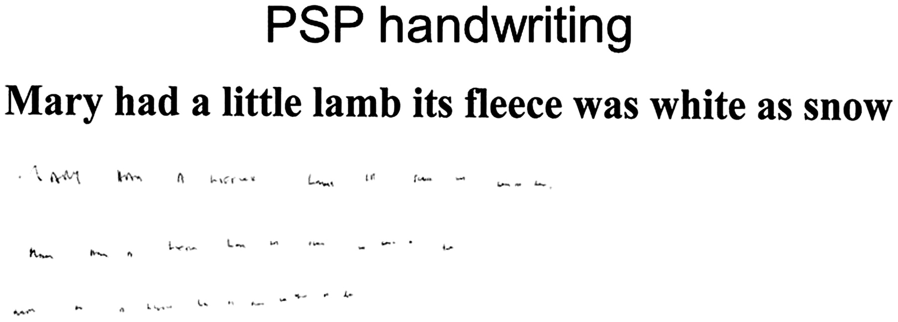 Example of a PD patient's handwriting (source)