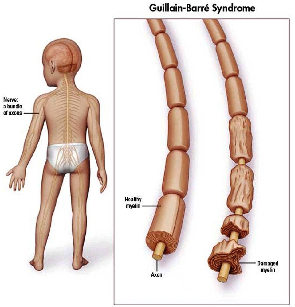 Guillain barre syndrome
