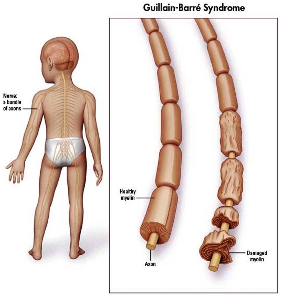 Guillain Barr Syndrome GBS Stepwards