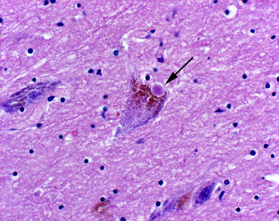 Lewy body seen in a patient with Parkinson disease