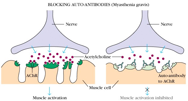 This condition is most often caused by auto-antibodies against postsynaptic nicotinic acetylcholine receptors (source) 